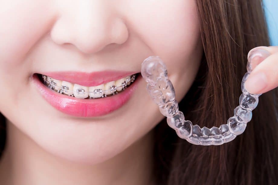 Aligners vs Traditional Braces Which is Right for You