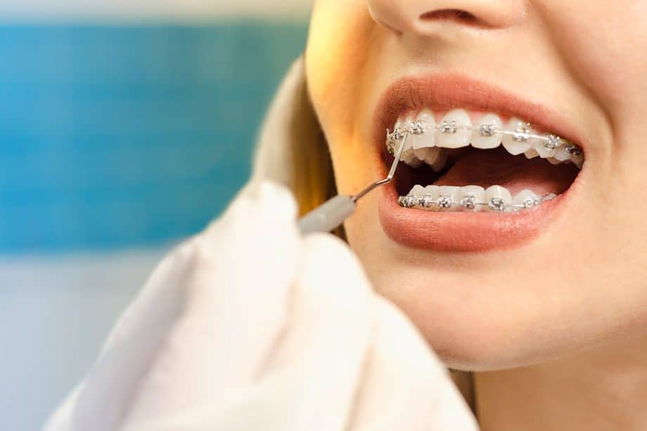 How Long Will I Need to Wear Braces?